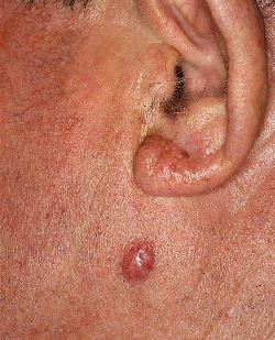 Skin cancer example