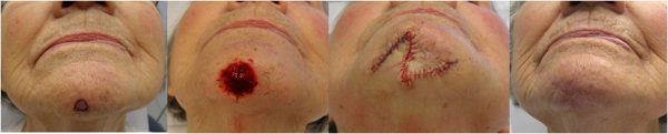Mohs chin surgery process