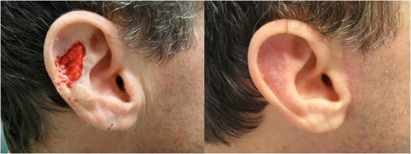 Mohs ear surgery process