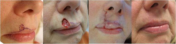 Mohs lip surgery process