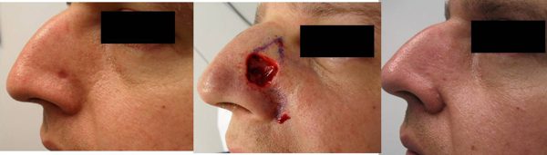 Mohs nose surgery process