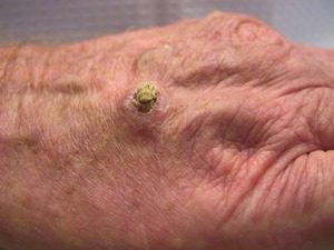 Skin cancer example