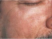 Port Wine Stains after treatment