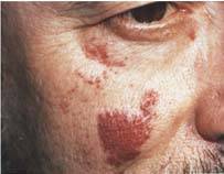 Port Wine Stains before treatment