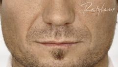 Restylane before treatment