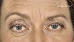 Restylane before treatment