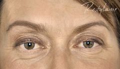 Restylane after treatment