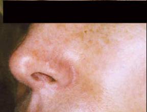 Rosacea after laser treatment