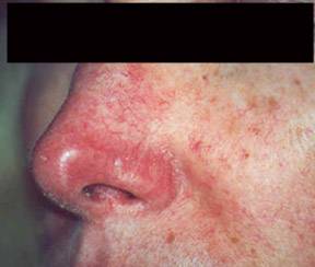 Rosacea before laser treatment