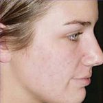 Acne after treatment
