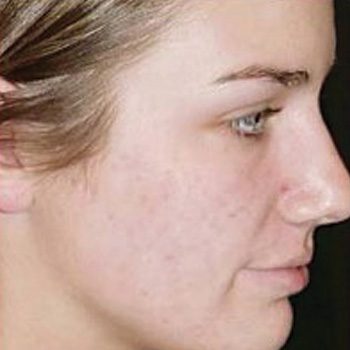 Acne after treatment