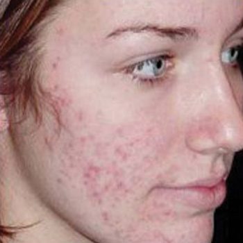 Acne before treatment
