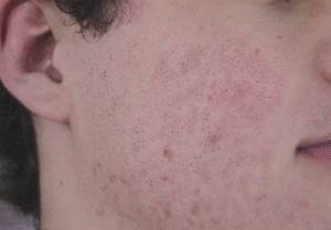 Acne after treatment