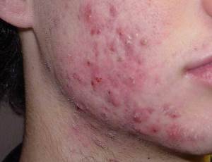 Acne before treatment