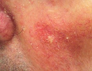 Actinic Keratosis
