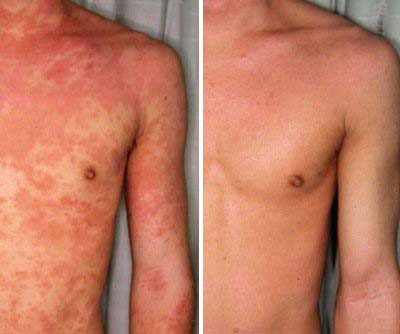 Eczema before and after