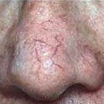 Facial spider veins before treatment