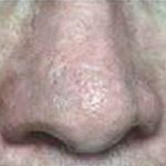 Facial spider veins after treatment