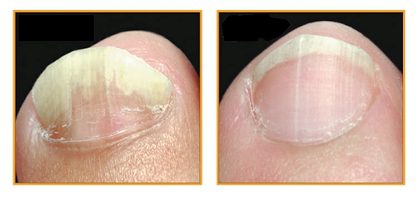 Nails before and after treatment