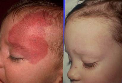 Port Wine before and after treatment