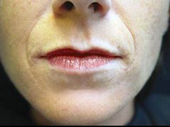 Restylane before treatment