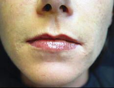 Restylane after treatment
