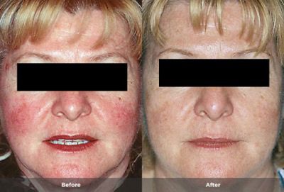 Rosacea before and after treatment