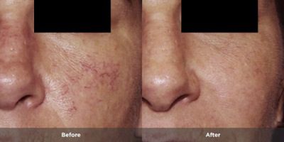 Telangiectasia before and after treatment