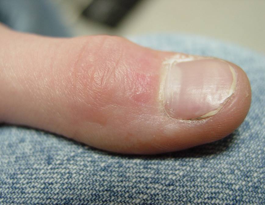 Warts after treatment