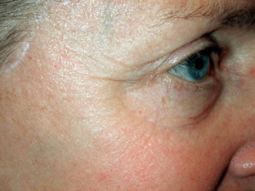Wrinkle reduction after treatment