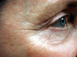 Wrinkle reduction before treatment